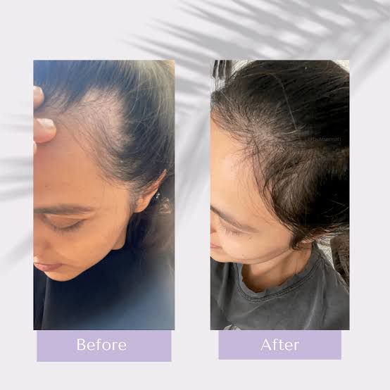 Nitya Sanjeevini Adivasi Herbal Hair Oil ✅👉